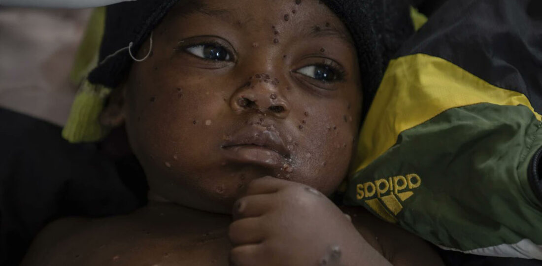 Mpox Situation In Africa Remains “Especially Concerning:” WHO