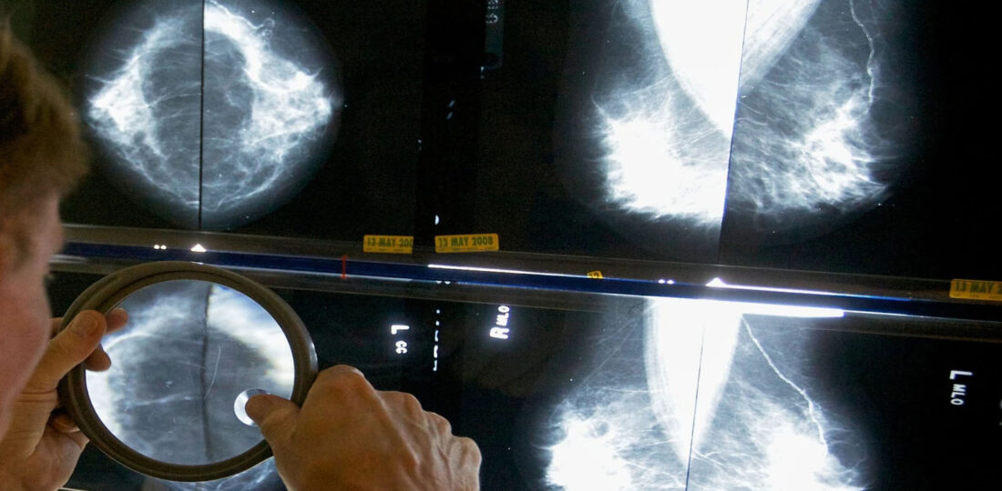 When Should You Get A Mammogram? Conflicting Advice Makes It Hard To Know